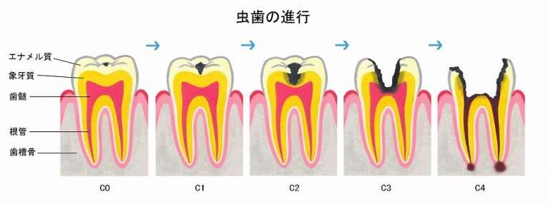 虫歯の症状別治療法