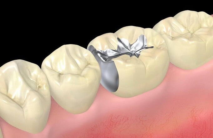 銀歯が虫歯になりやすい理由