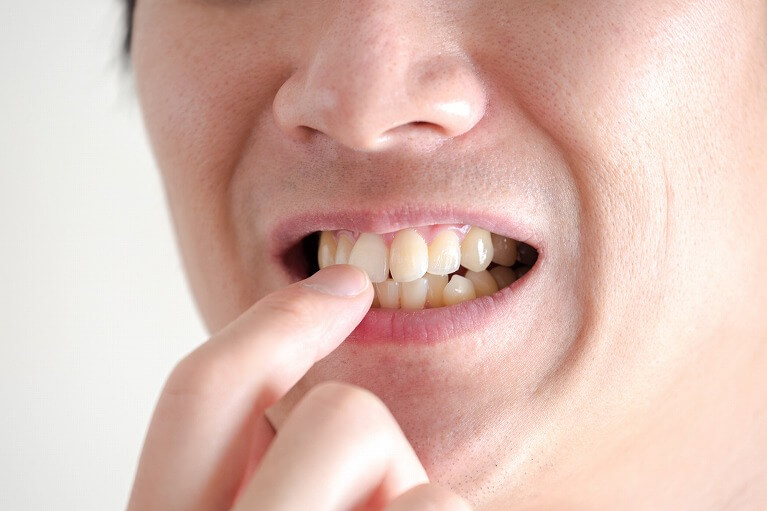 前歯2本の歯並びを治すのは矯正？セラミック？