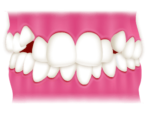 八重歯は抜歯して矯正するべき！？