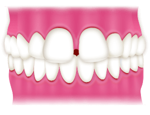 空隙歯列（すきっ歯）