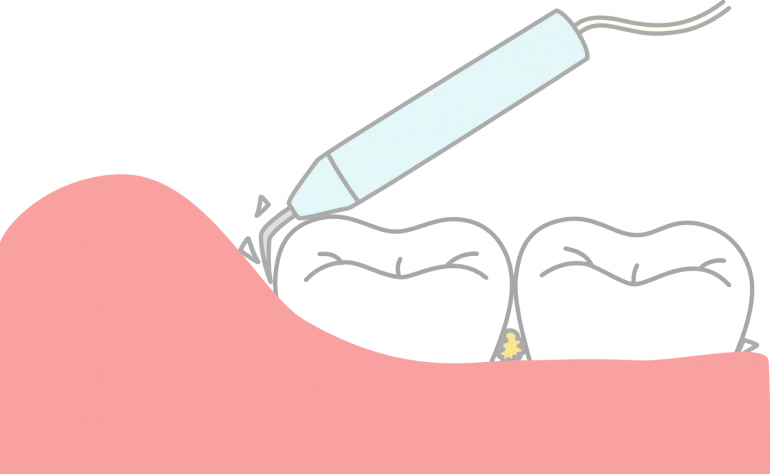 歯石は歯垢(プラーク)が石灰化したもの