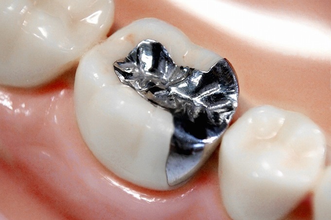 なぜ銀歯が虫歯になりやすいのか